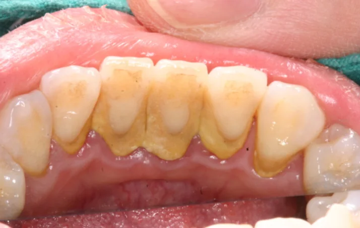 어금니 바깥쪽 잇몸에 치석이 넓게 침착되고 잇몸이 부어 있는 치주염 상태의 측면 구강내 임상사진